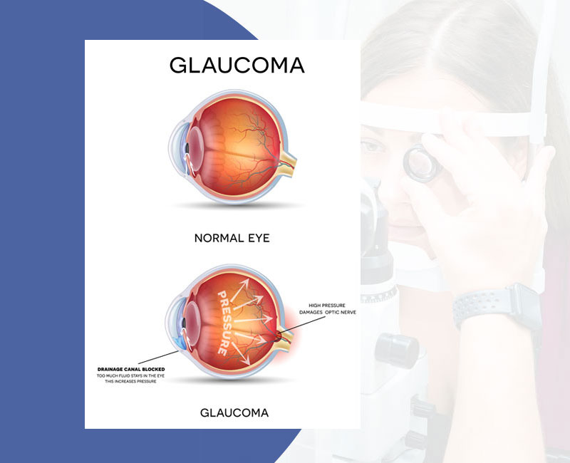 Glaucoma Clinic